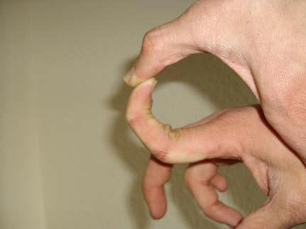 Bild 1. Zeigefinger rechte Hand, überstreckbare Finger